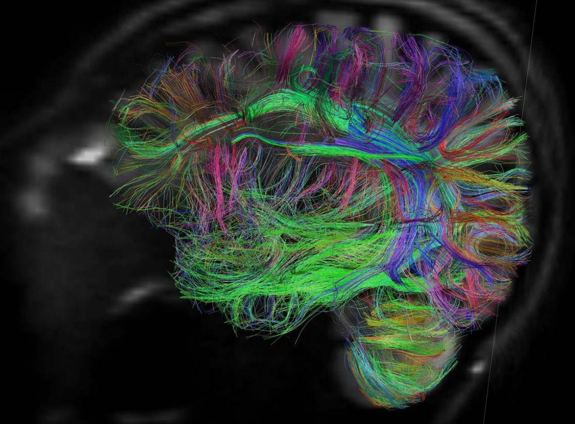 A diffusion spectrum image shows brain wiring in a healthy human adult. The threadlike structures are nerve bundles, each containing hundreds of thousands of nerve fibers. 